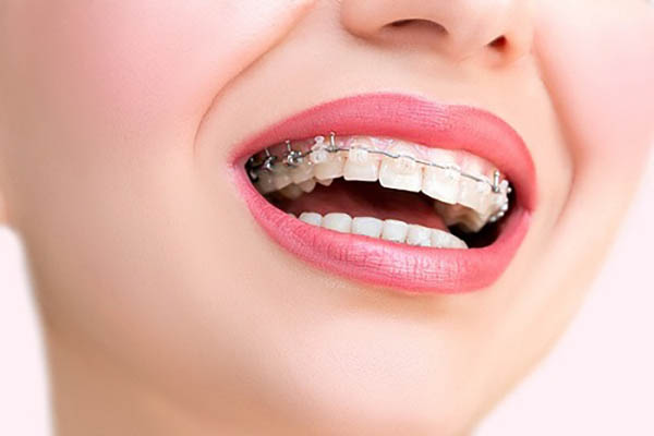 Tại sao cần niềng răng sớm khi răng sai lệch?