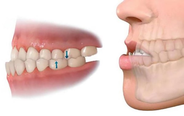 Ảnh hưởng của răng móm với bệnh nhân bao gồm: