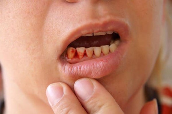 Niềng răng tại nhà có nhược điểm gì?