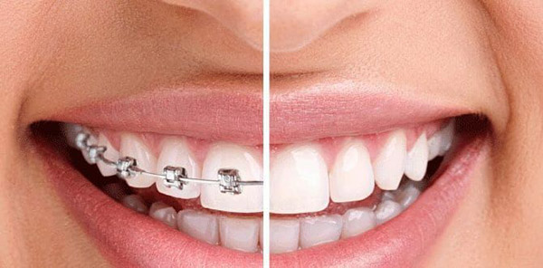 Trường hợp nào bạn có thể niềng răng một hàm?