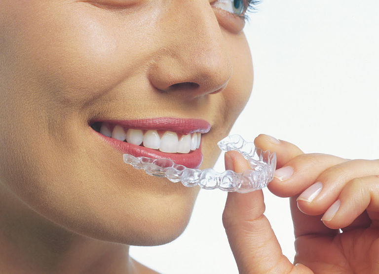 Niềng răng 3D Clear có hiệu quả không?