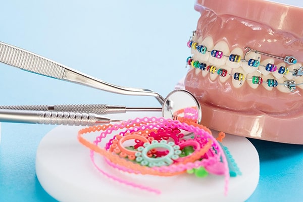Những điều bạn cần biết về niềng răng mắc cài kim loại